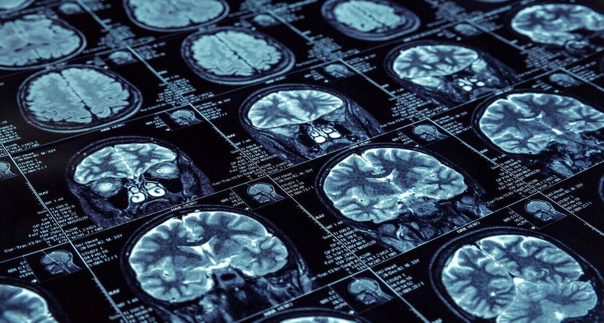 Neuroimaging Market