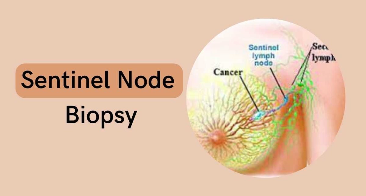 Sentinel Node Biopsy Market