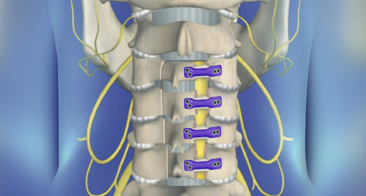 Spinal Laminoplasty Market